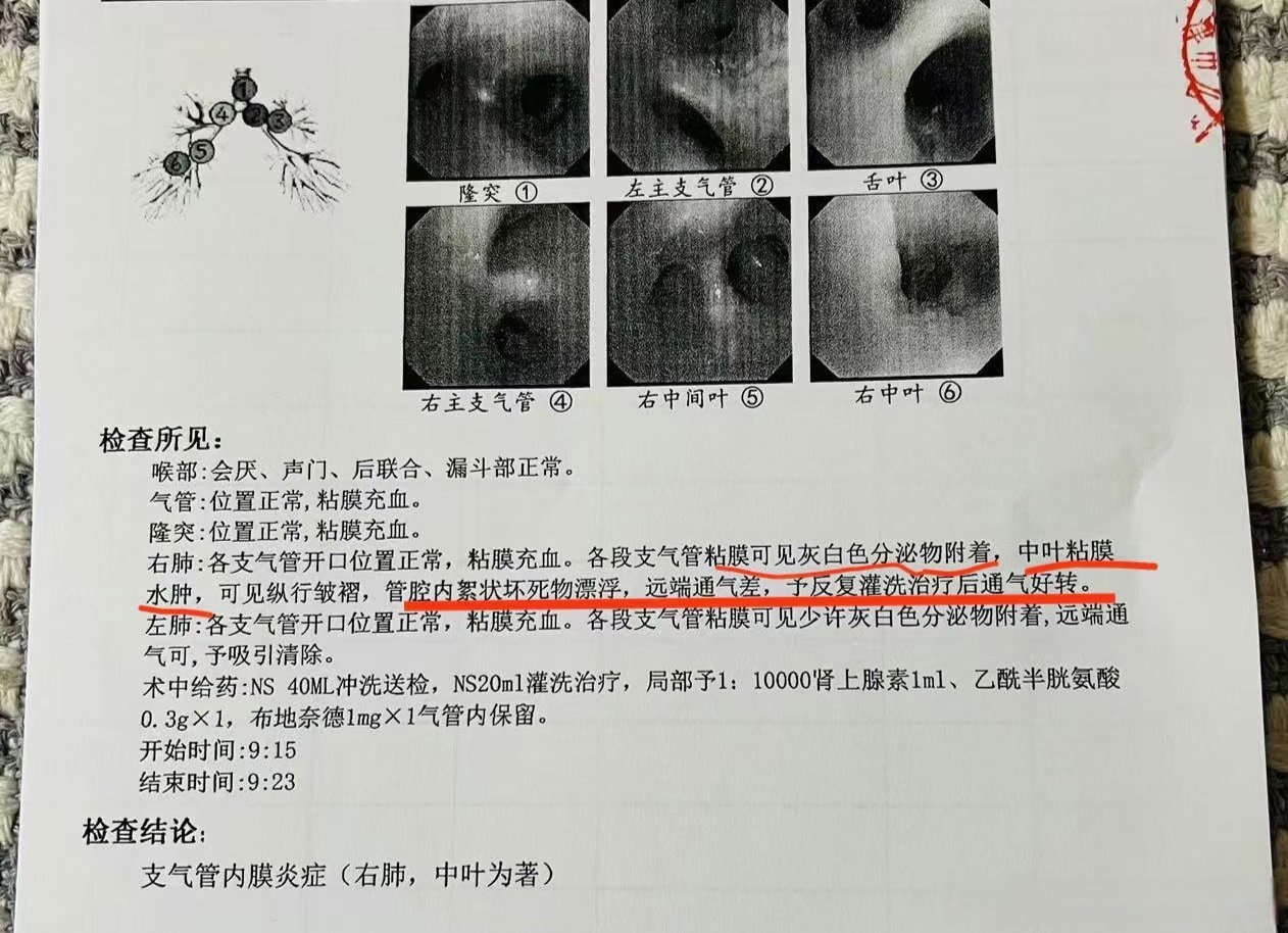 东莞肺炎病例︰(东莞肺炎病例详情)-第2张图片